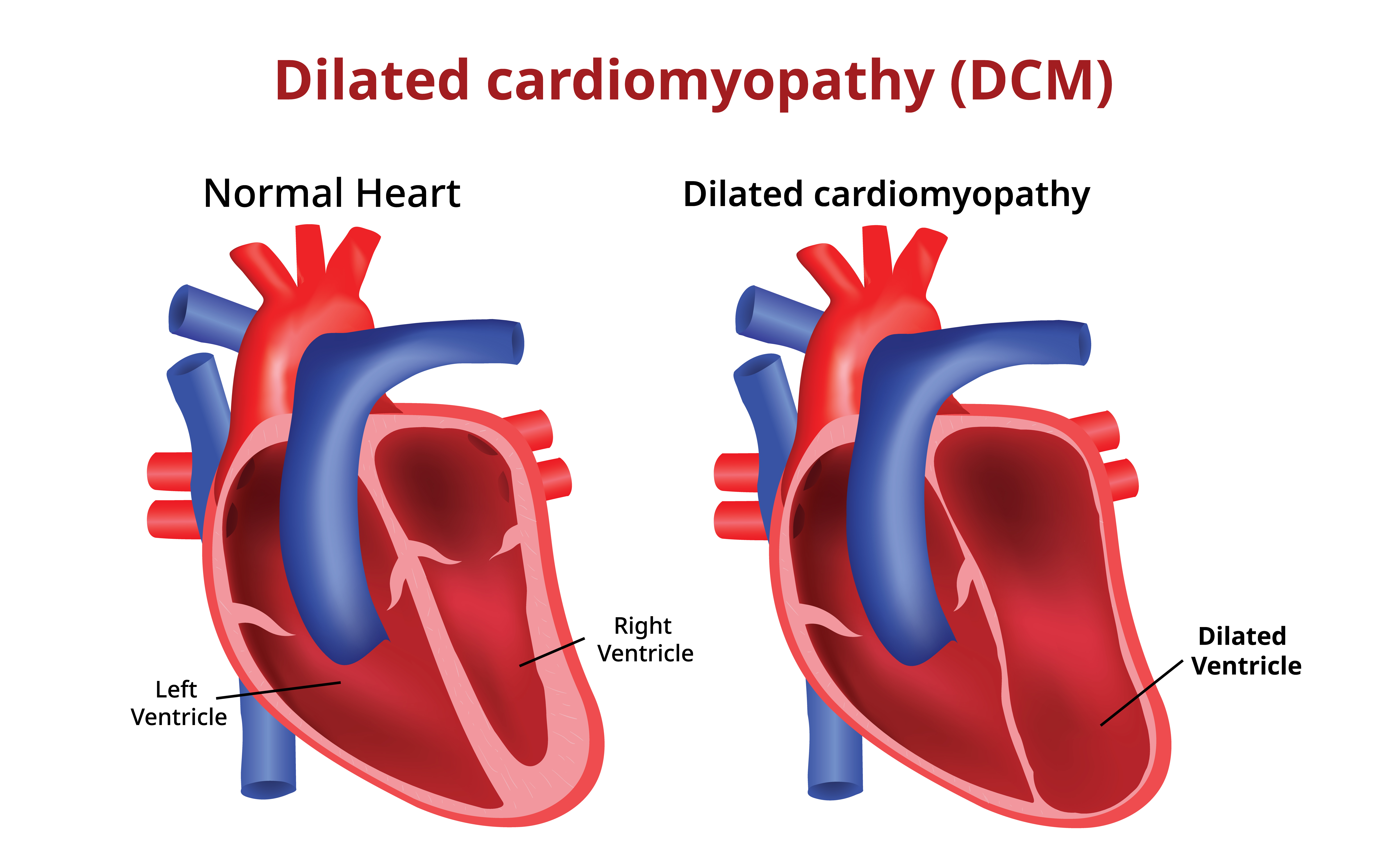 dilated cardiomyopathy